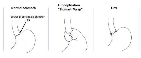 Illustration of the LINX Device